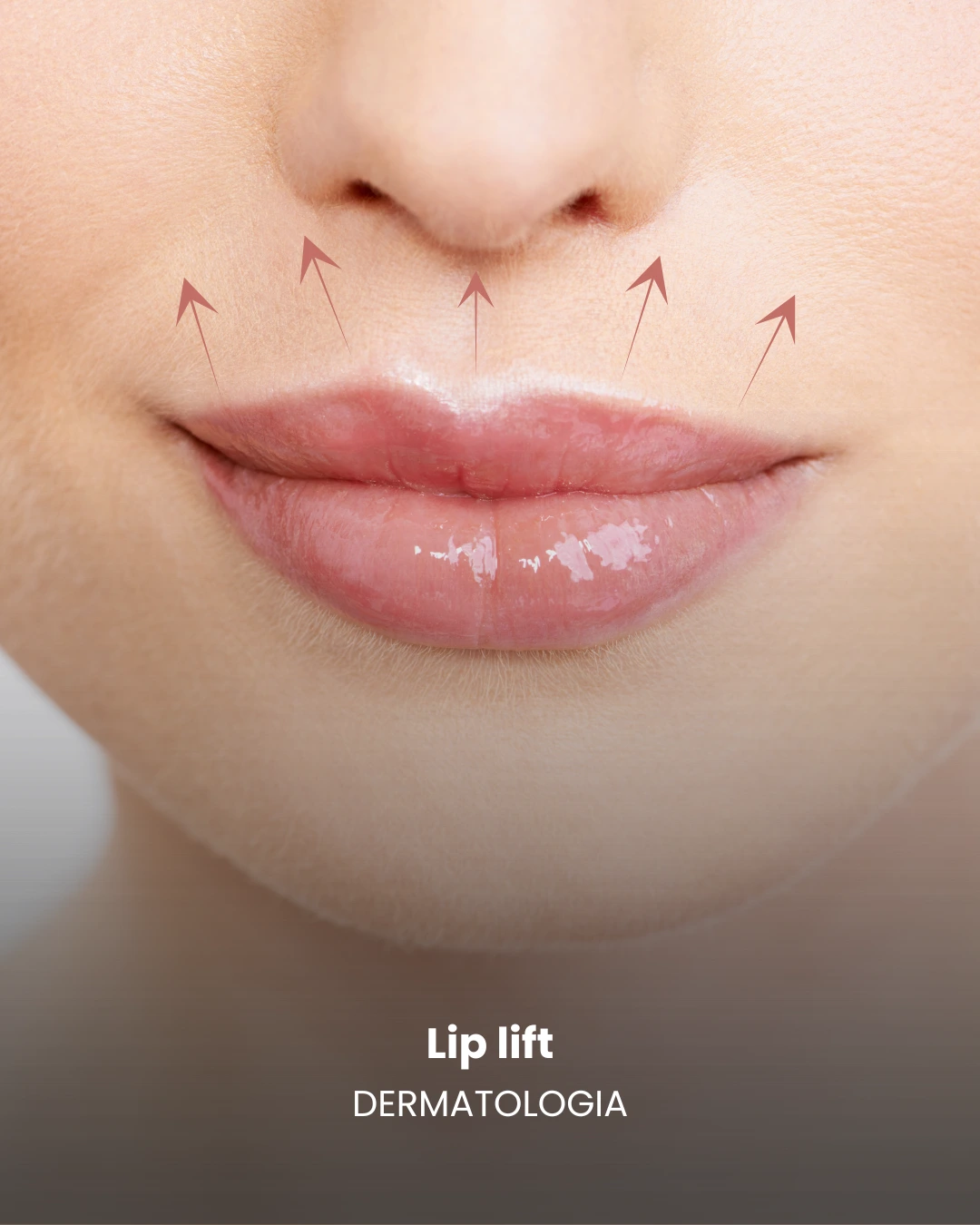 liplift