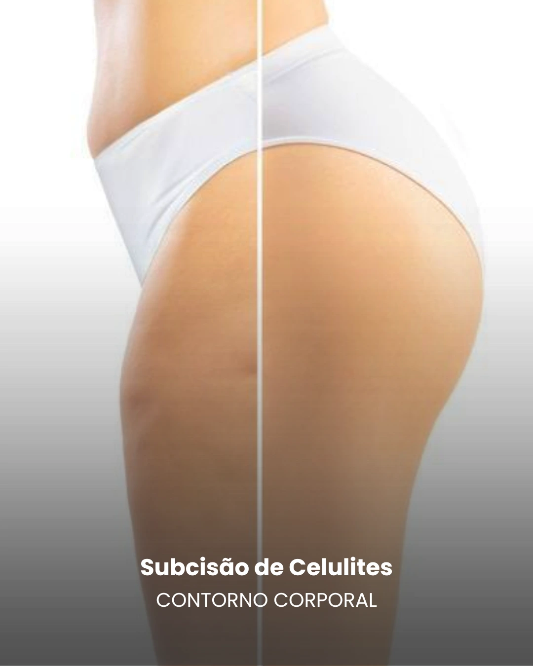 subcisaodecelulites